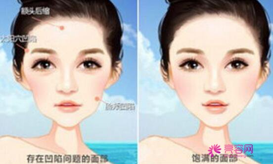 上海首尔丽格自体脂肪填充怎么样?价格案例分享
