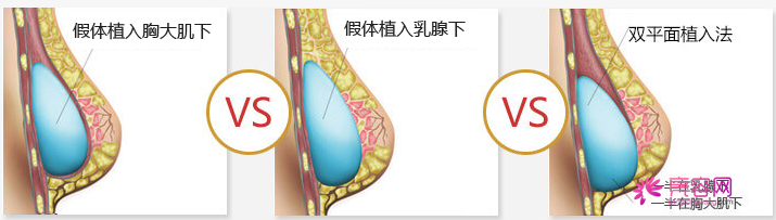 成都素美杨迪隆胸怎么样?价格案例分享