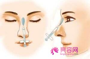 成都娇点李竞隆鼻怎么样?价格案例分享