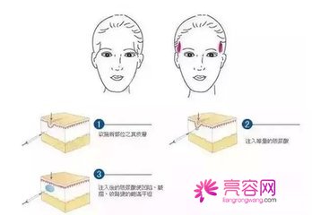成都玉之光刘中国自体脂肪填充怎么样?价格案例分享