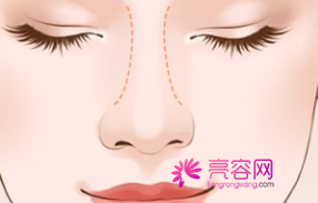 杭州格莱美陈笑隆鼻怎么样?价格案例分享