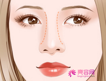北京米扬丽格巫文云隆鼻怎么样?价格案例分享