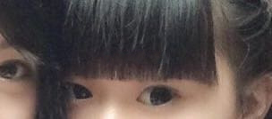 在成都铜雀台做的鼻整形,全切双眼皮、内眼角