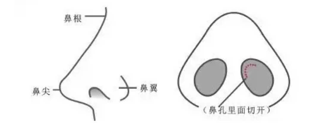 隆鼻做什么样的鼻子才好看?