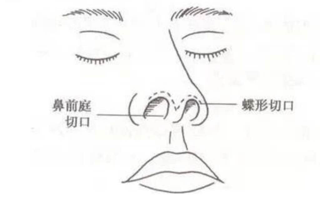 隆鼻做什么样的鼻子才好看?