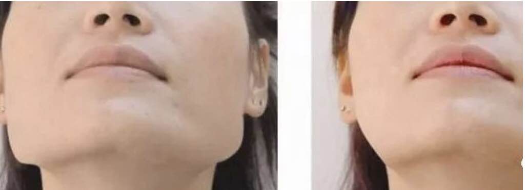 隆鼻术到底靠谱吗?适合的人群是什么?