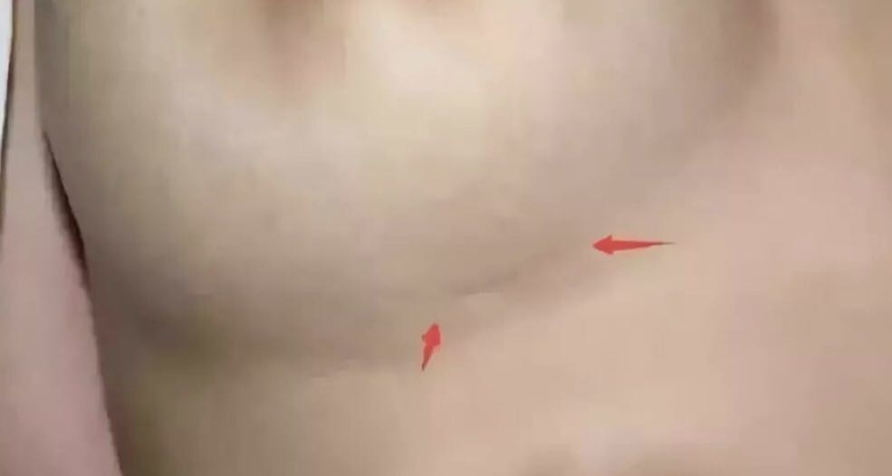 隆鼻术到底靠谱吗?适合的人群是什么?
