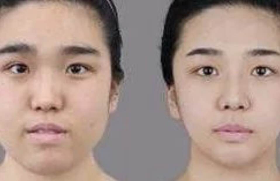 磨骨手术危险吗?能做到什么果?