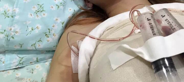 做完隆胸手术是什么样的的感觉?