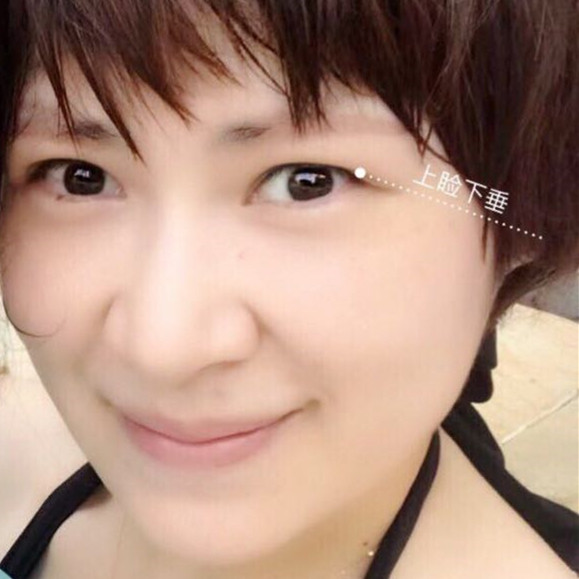 北京壹加壹张绿峰做的双眼皮