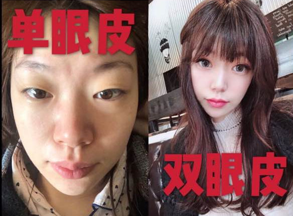 深圳美莱做双眼皮怎么样?美莱做的微创双眼皮