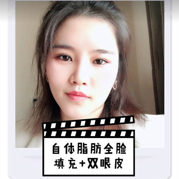 广州宸山医美做的双眼皮+自体脂肪填充
