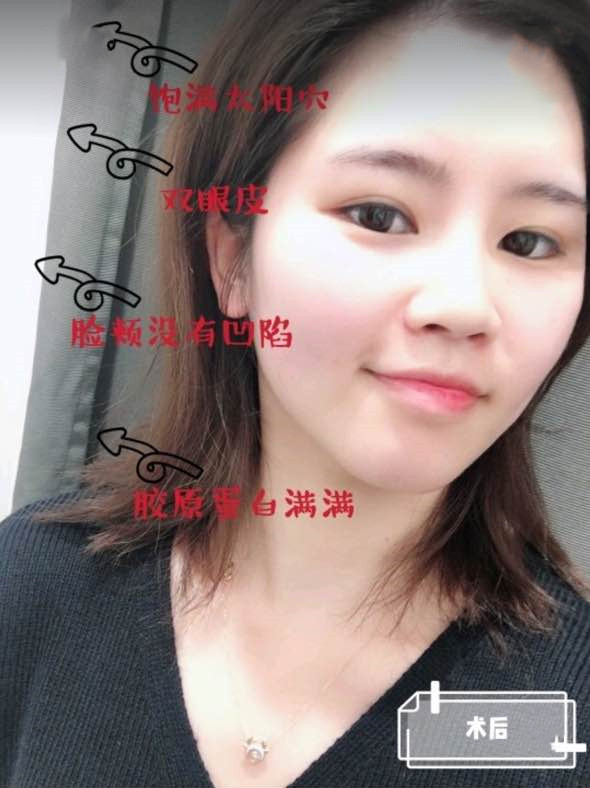 广州宸山医美做的双眼皮+自体脂肪填充