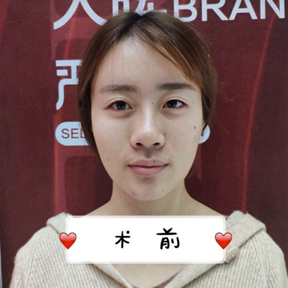 成都娇点做双眼皮怎么样?