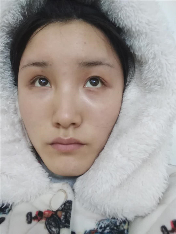 郑州华山胡斌自体脂肪全脸填充案例分享,价格,术后脸确实丰满圆润了许多,再也不是尖嘴猴腮了,哈哈哈哈~~~