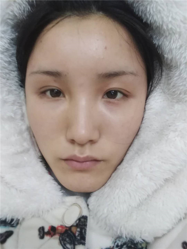 郑州华山胡斌自体脂肪全脸填充案例分享,价格,术后脸确实丰满圆润了许多,再也不是尖嘴猴腮了,哈哈哈哈~~~