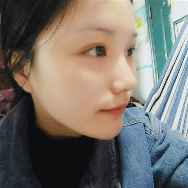 郑州华山胡斌自体脂肪全脸填充案例分享,价格,术后脸确实丰满圆润了许多,再也不是尖嘴猴腮了,哈哈哈哈~~~