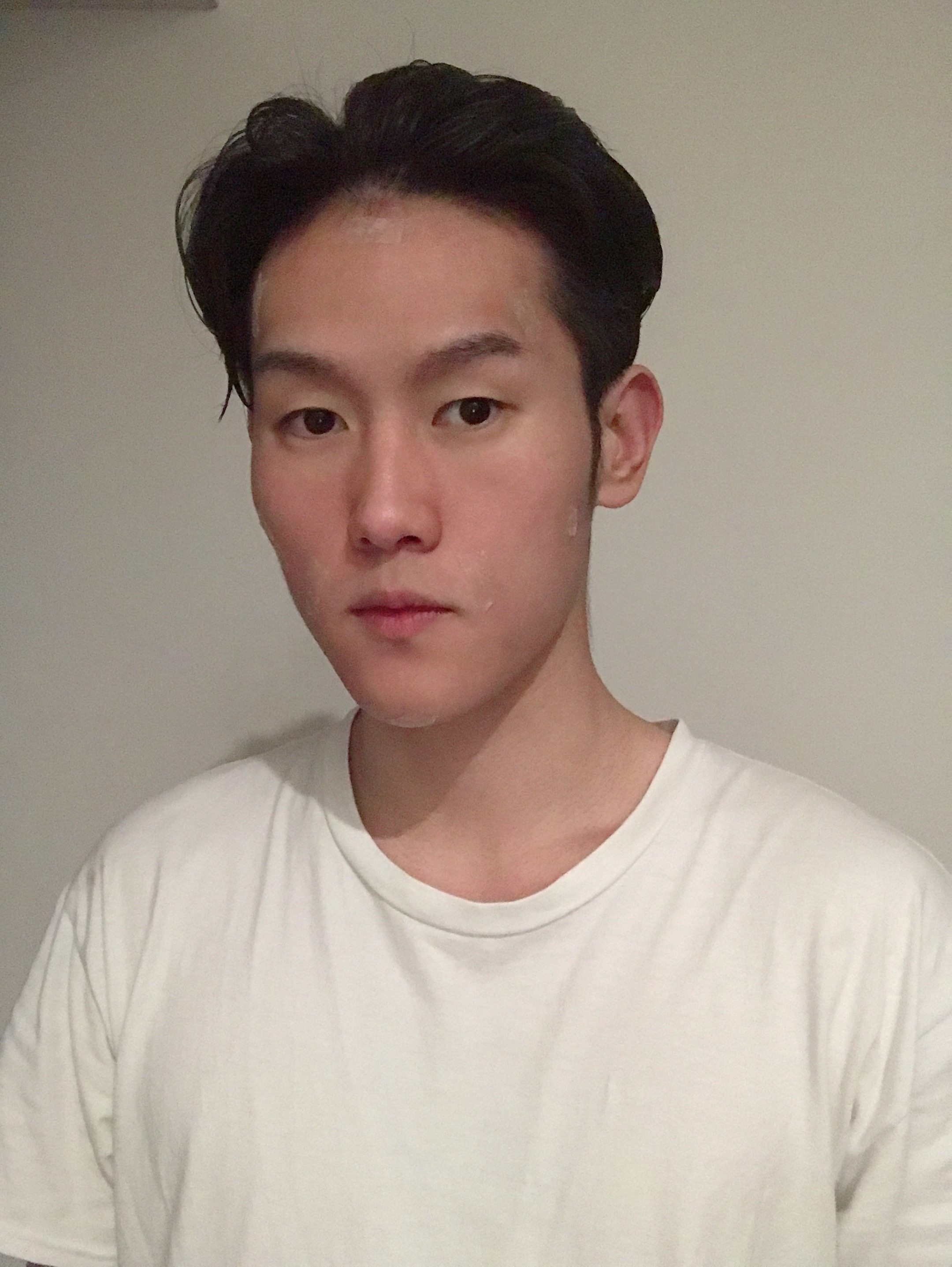 上海仁爱医院杨苓山自体脂肪全脸填充案例分享,男神的蜕变当时我就震惊了。