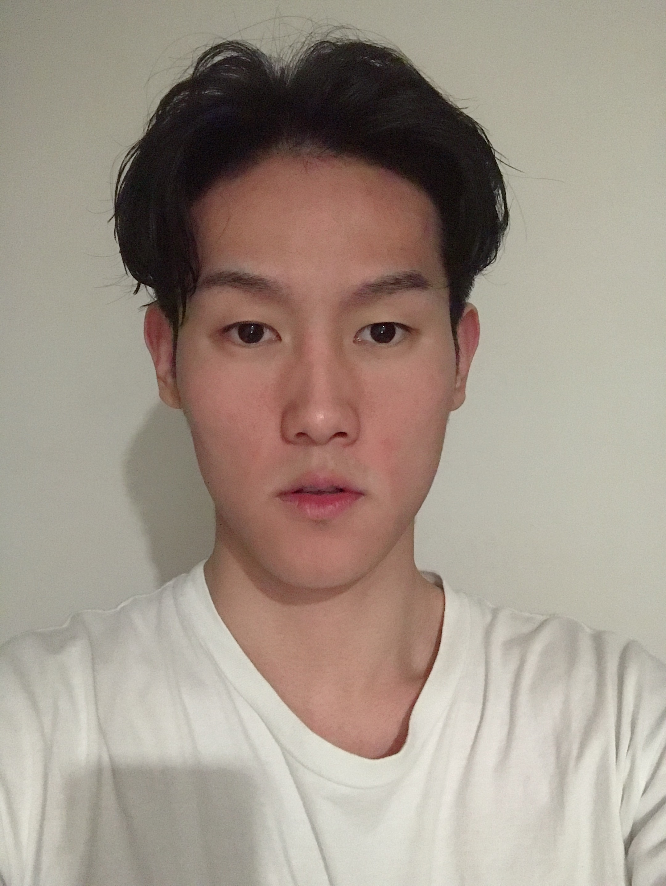 上海仁爱医院杨苓山自体脂肪全脸填充案例分享,男神的蜕变当时我就震惊了。
