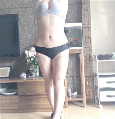 合肥崔劲松医疗美容崔向葵吸脂瘦腰腹案例价格分享,胖妞的改造之旅。