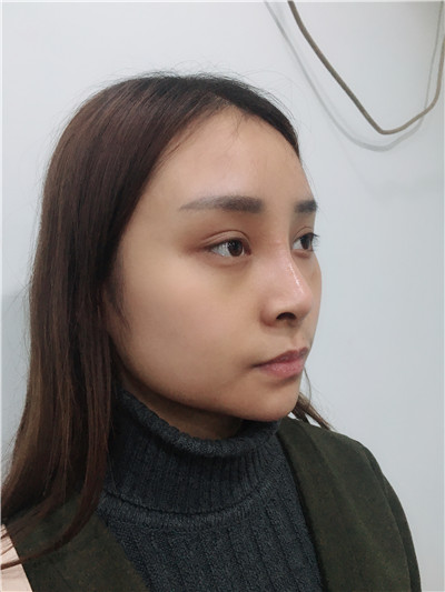 太原时光整形美容医院张国军硅胶隆鼻案例价格分享,鼻子变好看对一张脸的改变有多大?