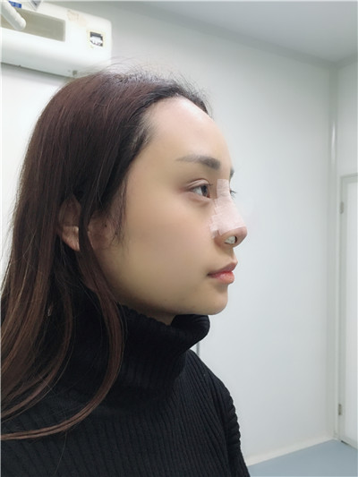太原时光整形美容医院张国军硅胶隆鼻案例价格分享,鼻子变好看对一张脸的改变有多大?