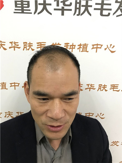 重庆华肤皮肤病医院植发科种植发际线案例价格分享,之前头顶地中海显老又难看,改变后年轻了很多。