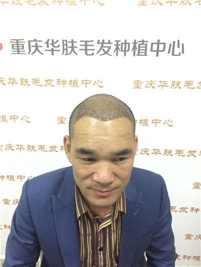 重庆华肤皮肤病医院植发科种植发际线案例价格分享,之前头顶地中海显老又难看,改变后年轻了很多。