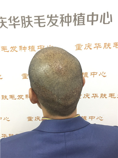 重庆华肤皮肤病医院植发科种植发际线案例价格分享,之前头顶地中海显老又难看,改变后年轻了很多。