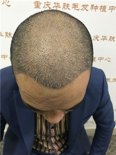 重庆华肤皮肤病医院植发科种植发际线案例价格分享,之前头顶地中海显老又难看,改变后年轻了很多。