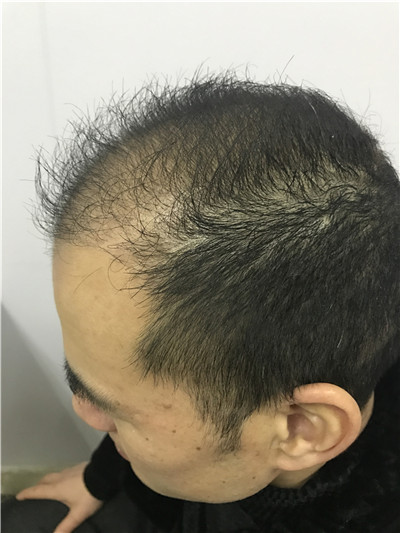 重庆华肤皮肤病医院植发科种植发际线案例价格分享,之前头顶地中海显老又难看,改变后年轻了很多。