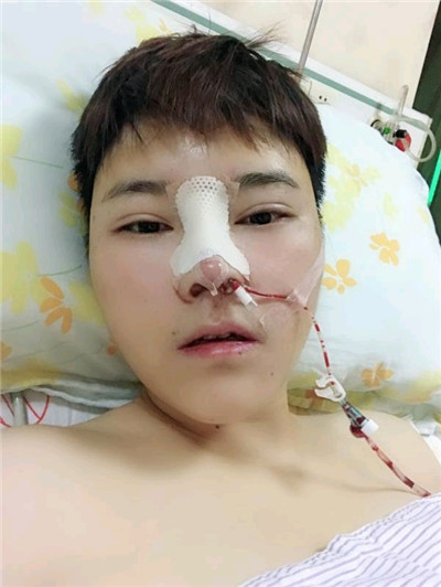 广州韩妃整形美容杨德发肋软骨隆鼻案例价格分享,男孩子鼻子高挺起来整个人都变精神了。