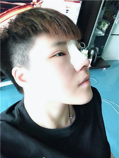 广州韩妃整形美容杨德发肋软骨隆鼻案例价格分享,男孩子鼻子高挺起来整个人都变精神了。