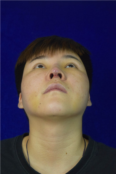 广州韩妃整形美容杨德发肋软骨隆鼻案例价格分享,男孩子鼻子高挺起来整个人都变精神了。