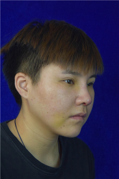广州韩妃整形美容杨德发肋软骨隆鼻案例价格分享,男孩子鼻子高挺起来整个人都变精神了。