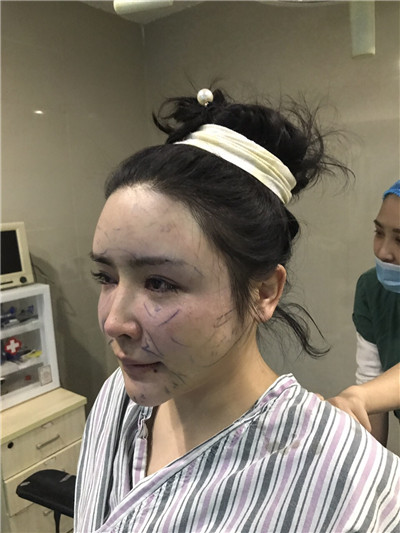 重庆铂生杜亚旭面部填充案例价格分享,做完之后她成为了平面模特~