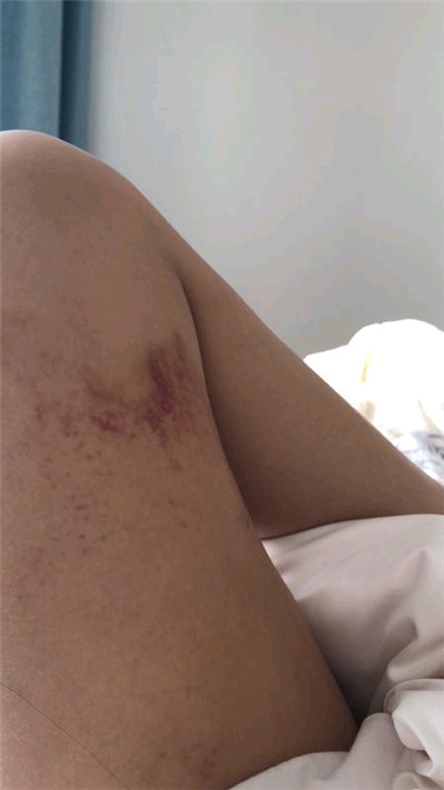 天津奥薇丛相文自体脂肪隆胸案例价格分享,男同事看我的眼光都变了,领导也关注到了我,感觉我要恋爱了!