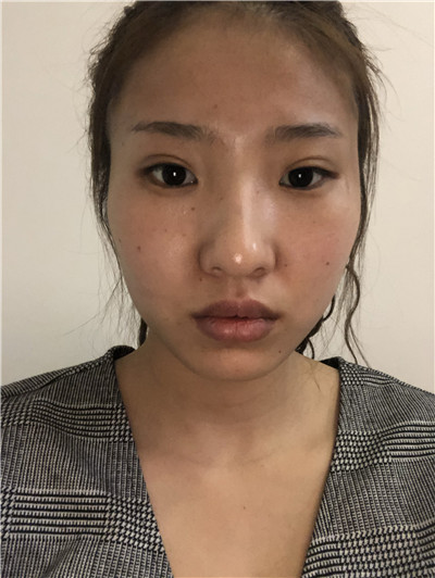 北京艾玛韦元强面部填充案例价格分享,自然到完全看不出来做过填充就是感觉年轻了很多~~