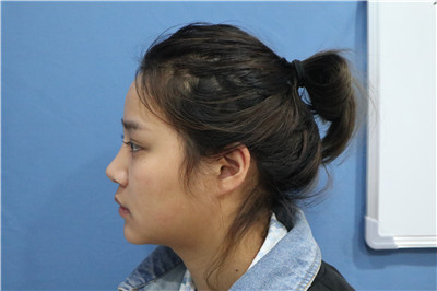 杭州格莱美张龙鼻部手术案例价格分享,现在的鼻子自然又漂亮~
