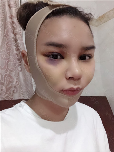 杭州格莱美张龙鼻部手术案例价格分享,现在的鼻子自然又漂亮~