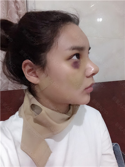 杭州格莱美张龙鼻部手术案例价格分享,现在的鼻子自然又漂亮~