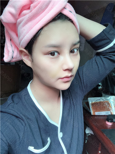 杭州格莱美张龙鼻部手术案例价格分享,现在的鼻子自然又漂亮~