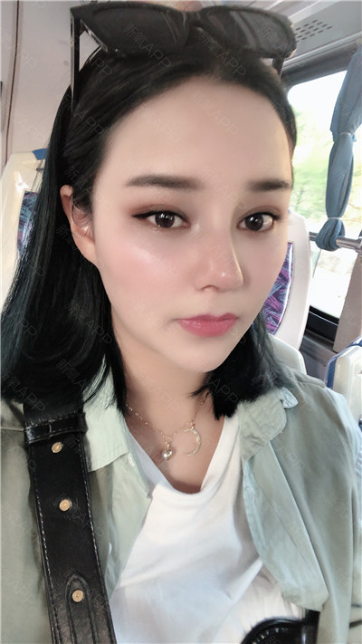 杭州格莱美张龙鼻部手术案例价格分享,现在的鼻子自然又漂亮~