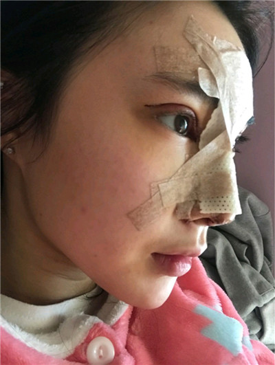 韩国 POP金东杰鼻部手术案例价格分享,这是我见过较自然的鼻子!