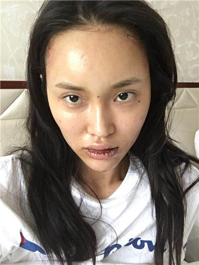 北京百达丽苏婷厚唇改薄案例价格分享,厚嘴唇终于有救了!