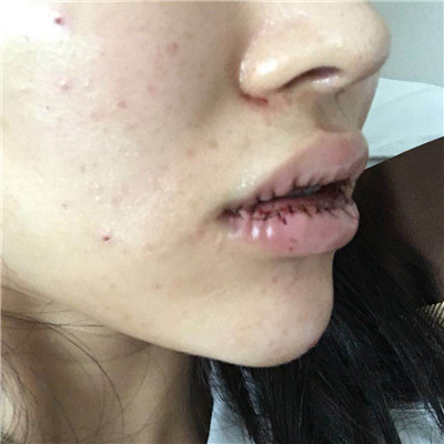 北京百达丽苏婷厚唇改薄案例价格分享,厚嘴唇终于有救了!