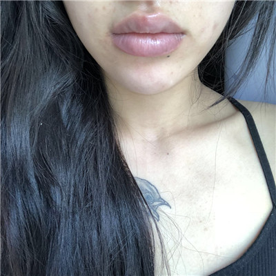 北京百达丽苏婷厚唇改薄案例价格分享,厚嘴唇终于有救了!