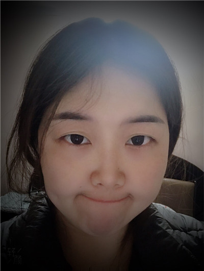 上海九院张盈帆双眼皮案例价格分享,做完全切竟然连疤痕都看不见!