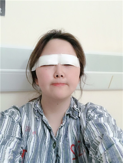上海九院张盈帆双眼皮案例价格分享,做完全切竟然连疤痕都看不见!