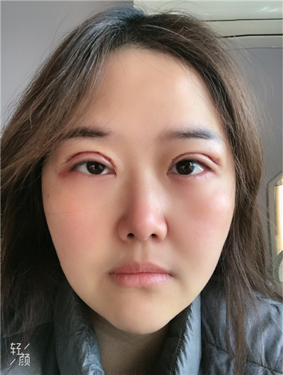 上海九院张盈帆双眼皮案例价格分享,做完全切竟然连疤痕都看不见!